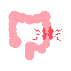 Abdominal Cancers