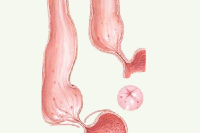 Achalasia Cardia Drvikas Singla