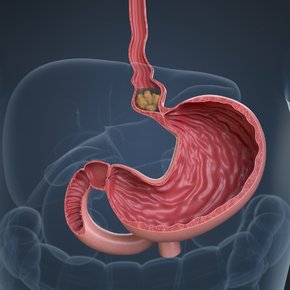 Achalasia [Oesophageal Diseases Treatment]