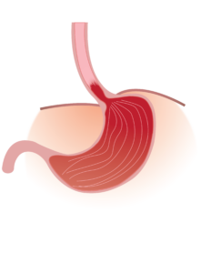 Barret Esophagus 02
