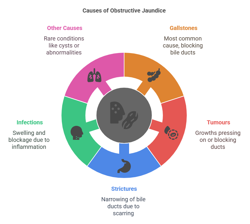 Causes Of Obstructive Jaundice Visual Selection