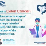 Know about the Colon Cancer