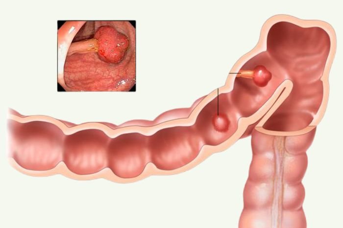 Colonic Polyps And Cancer