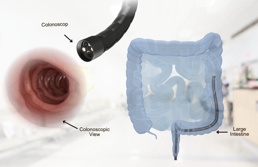 Colonscopy 1 Colonscopy 1
