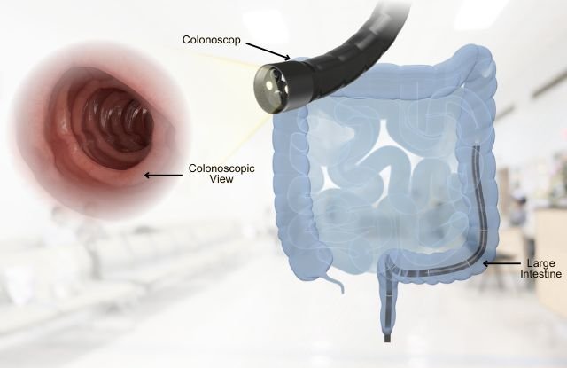 Colonscopy Colonscopy