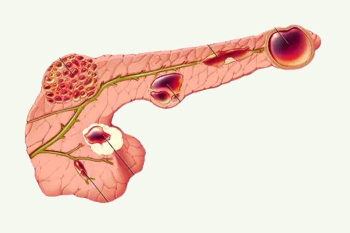 Cystic Neoplasm Of Pancreas