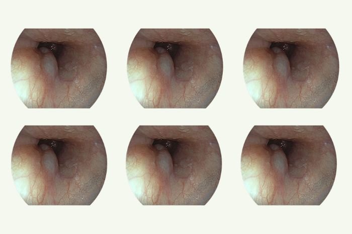 Duplication Cyst Of Esophagus