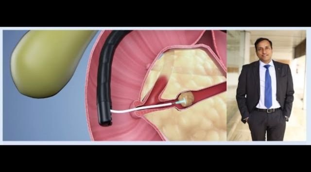 Endoscopic Techniques for Stone Removal in Chronic Pancreatitis