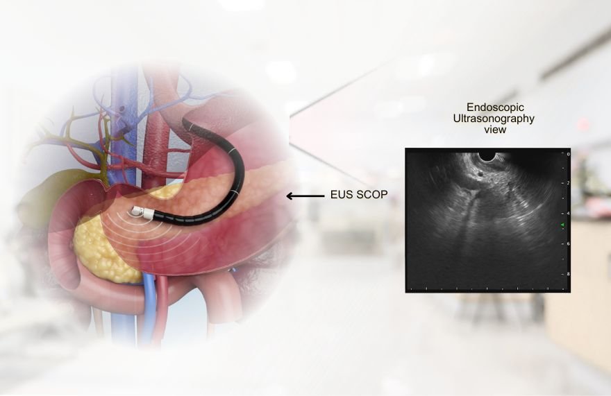 Endoscopic Ultrasonography Eus 2 Endoscopic Ultrasonography (Eus) 2