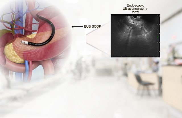 Endoscopic Ultrasonography Eus Endoscopic Ultrasonography (Eus)