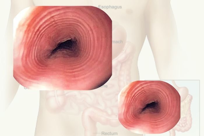 Eosinophilic Esophagitis