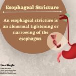 Esophageal Stricture 1