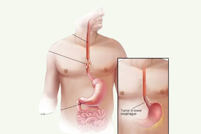 Esophageal Stricture &Amp; Web