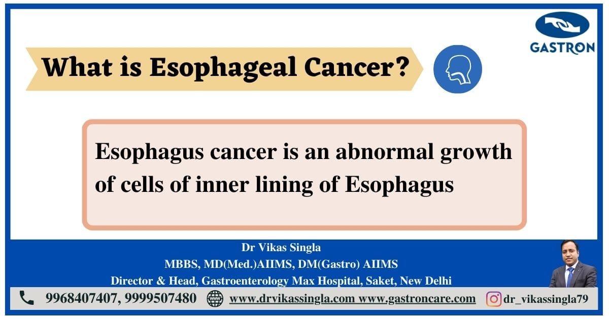 Esophageal Cancer | Dr. Vikas Singla