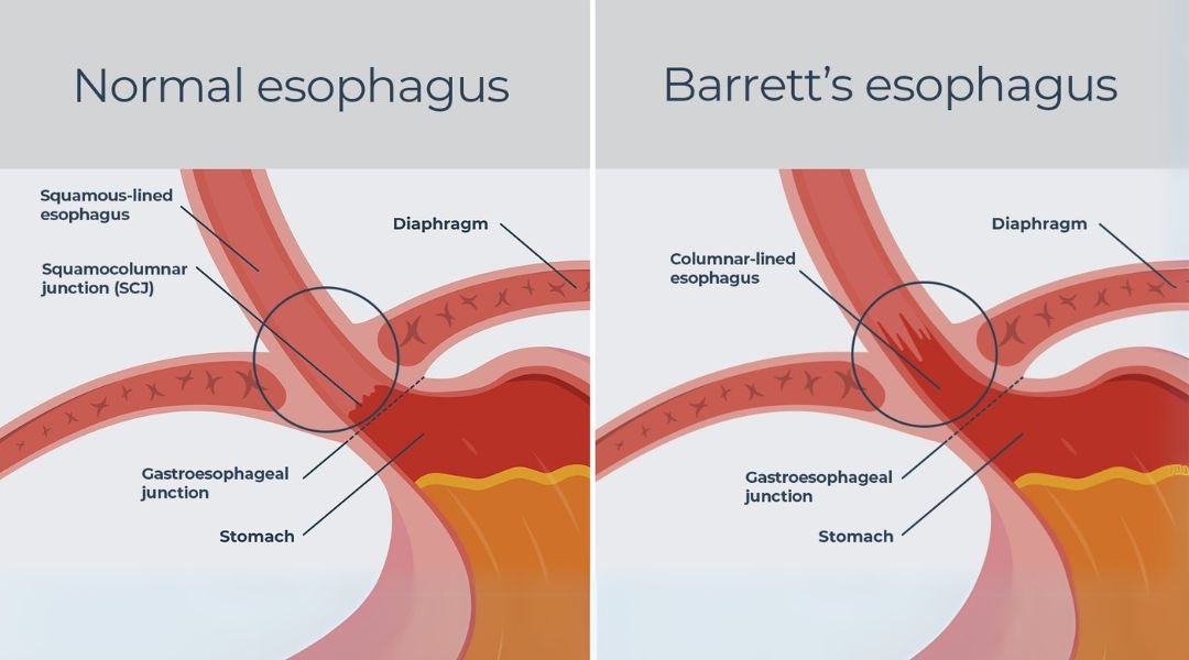 Esophagus With Normal And Barretts Lining Side By Side
