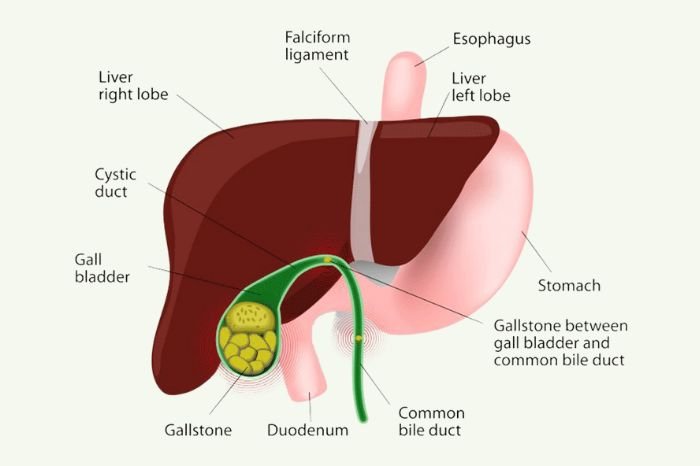 Gall Bladder Stone