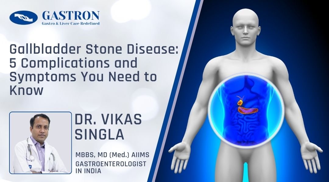 Gallbladder Stone Disease 5 Complications and Symptoms You Need to Watch For