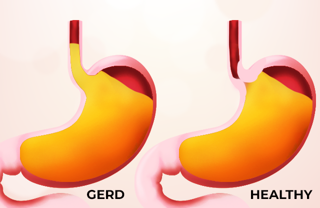 GERD (Gastroesophageal Reflux Disease) | Dr. Vikas Singla