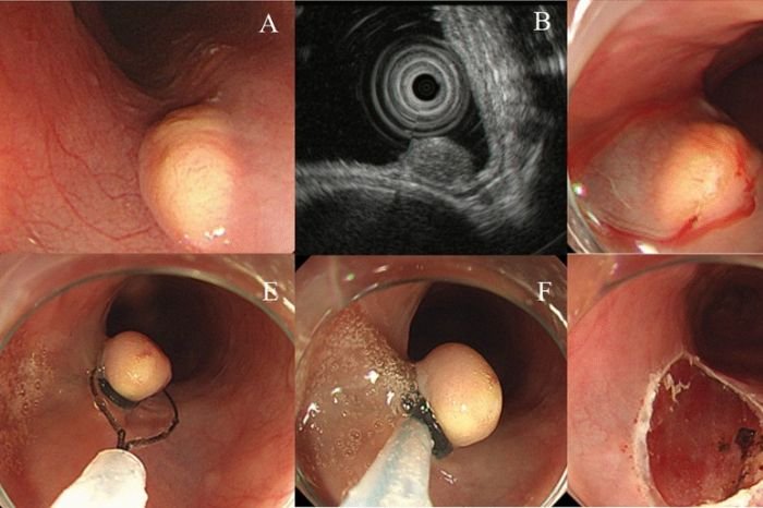 Granular Cell Tumor Of Esophagus
