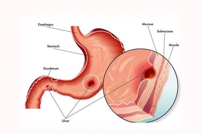 H Pylori Infection (2)