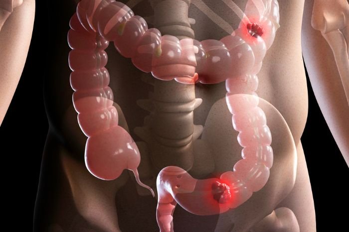 Irritable Bowel Syndrome