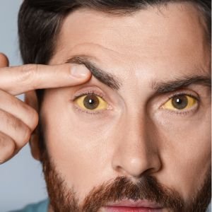 Jaundice – Yellowing Of The Skin And Whites Of Eyes