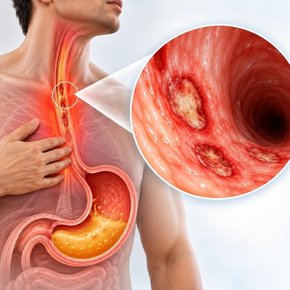 Oesophageal Ulcers