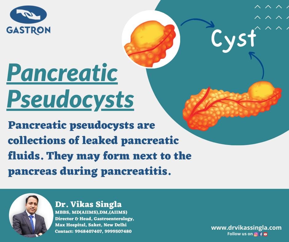 Pancreatic Pseudocysts