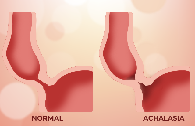 achalasia cardia, Illustration: Achalasia Cardia - Exploring the Esophageal Disorder