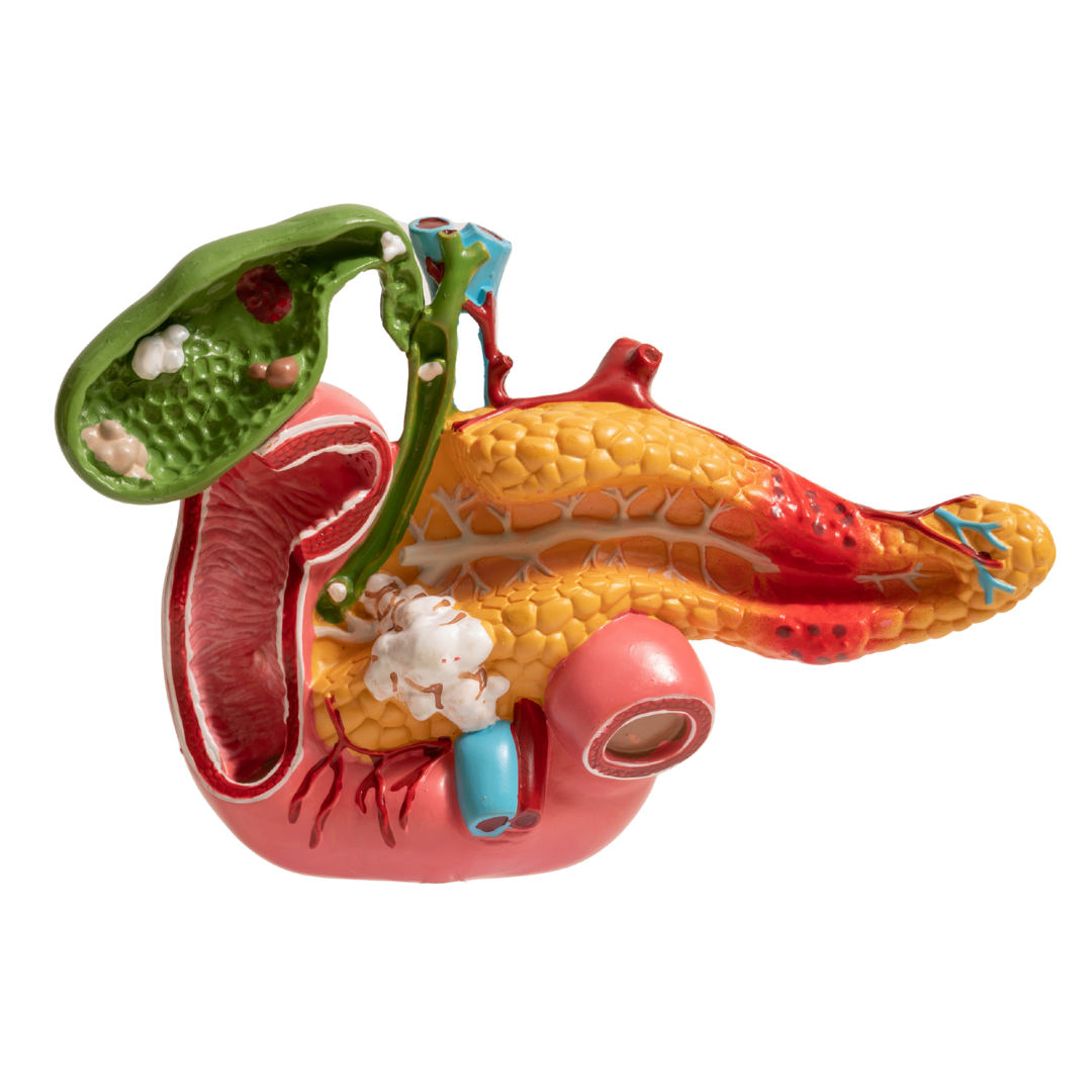 Autoimmune Pancreatitis