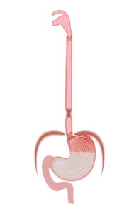 esophageal stricture