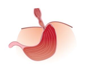 Esophageal Stricture 01