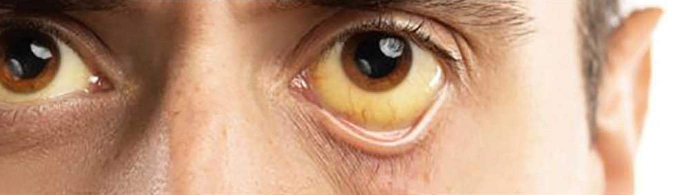 Comprehensive Guide to Jaundice: Causes, Symptoms, and Treatment | Best ...