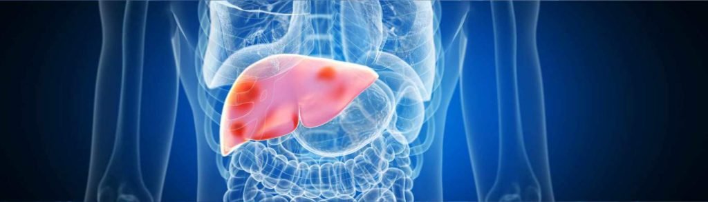 Cirrhosis - Liver Disease - Dr. Vikas Singla - Gastroentrologist - DGOC